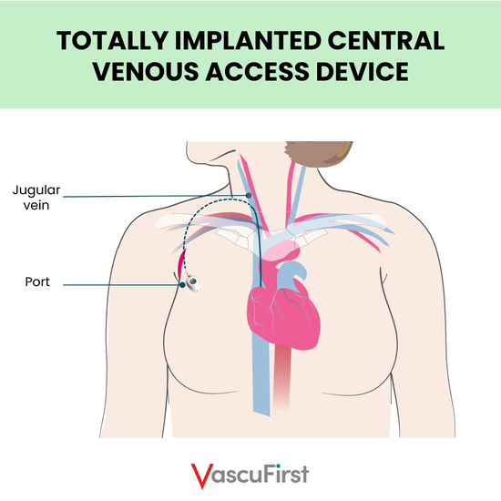 Understanding Chest and Neck Veins for Vascular Access: A Comprehensive Overview, by Dr Linda Kelly